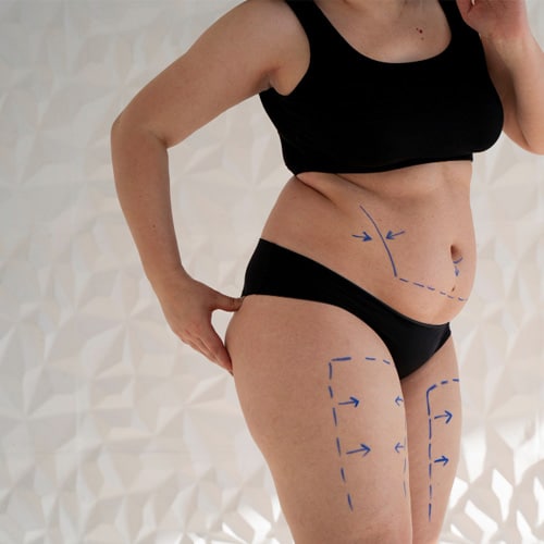 liposuction milwaukee