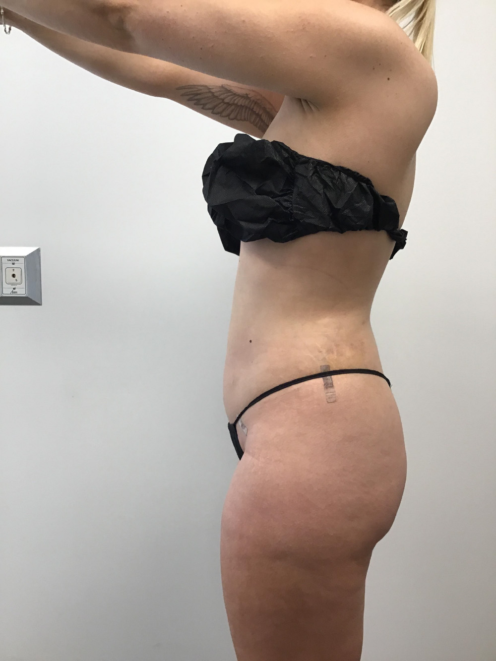 Liposuction vs Tummy Tuck: Which Is Better?