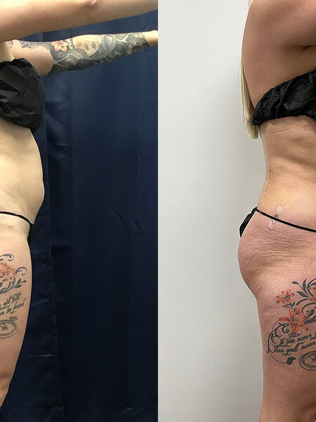 liposuction 1 month
