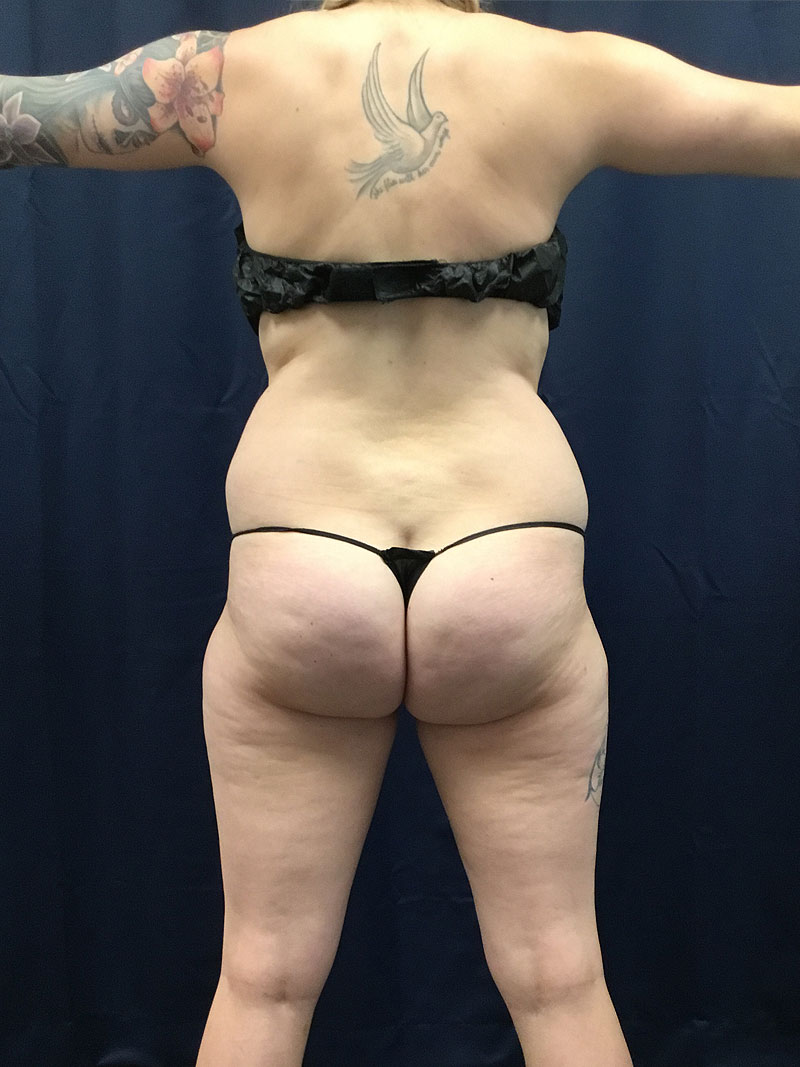 back 29 28 liposuction