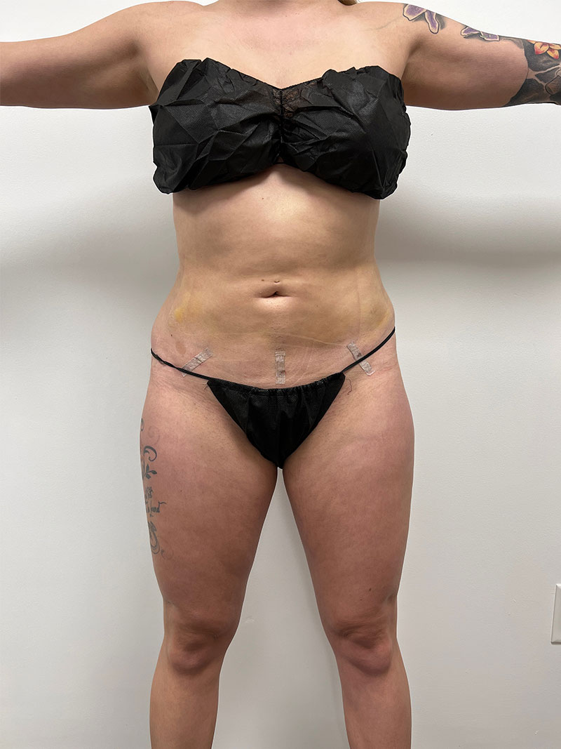 front 29 28 liposuction post