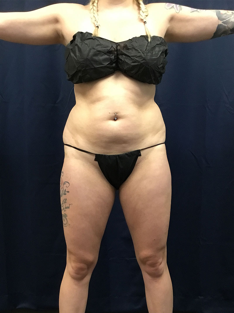 front 29 28 liposuction